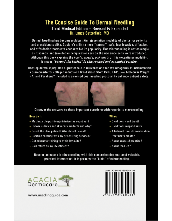 The Concise Guide to Dermal Needling Third Medical Edition - Revised & Expanded by Dr. Lance Setterfield (ISBN: 9780992060411) - Paperback
