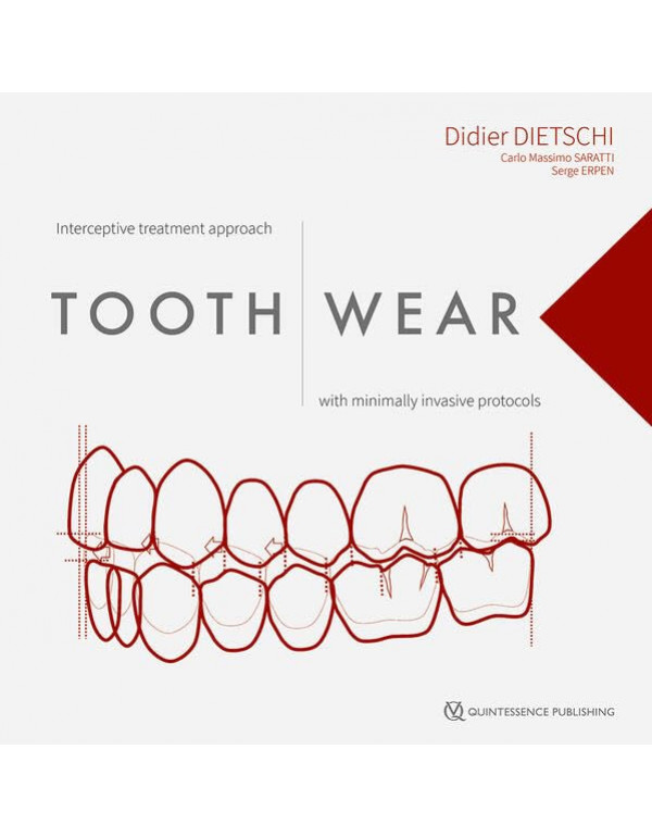 Tooth Wear: Interceptive Treatment Approach With Minimally Invasive Protocols by Didier Dietschi, Carlo Massimo Saratti, Serge Erpen *US HARDCOVER*